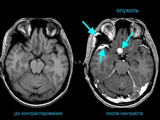 разница МРТ головного мозга с контрастом и без на снимке